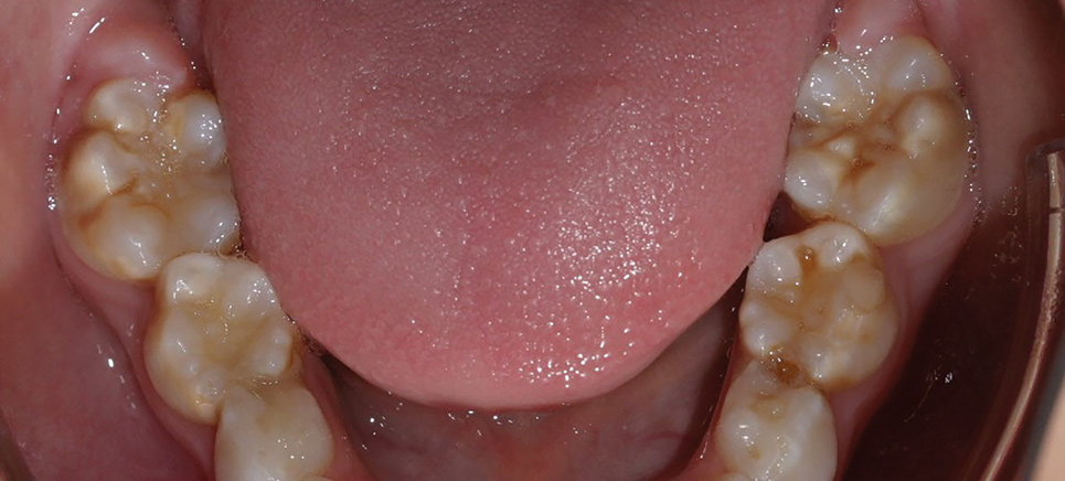 Blick auf Zunge und Zähne in einem Unterkiefer